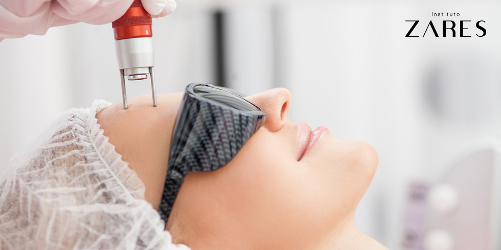 Resurfacing Facial a Laser: Benefícios Para o Rejuvenescimento
